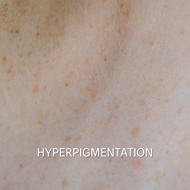 01 Pojacana Pigmentacija