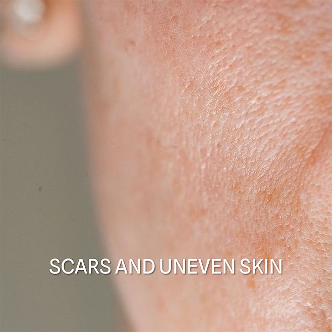 02 Oziljci I Neravna Koza