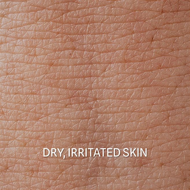 03 Suva Iritirana Koza