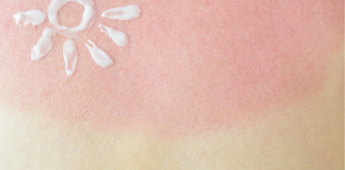 letnji-sos-kako-oporaviti-kozu-posle-suncanja-mora-i-hlora