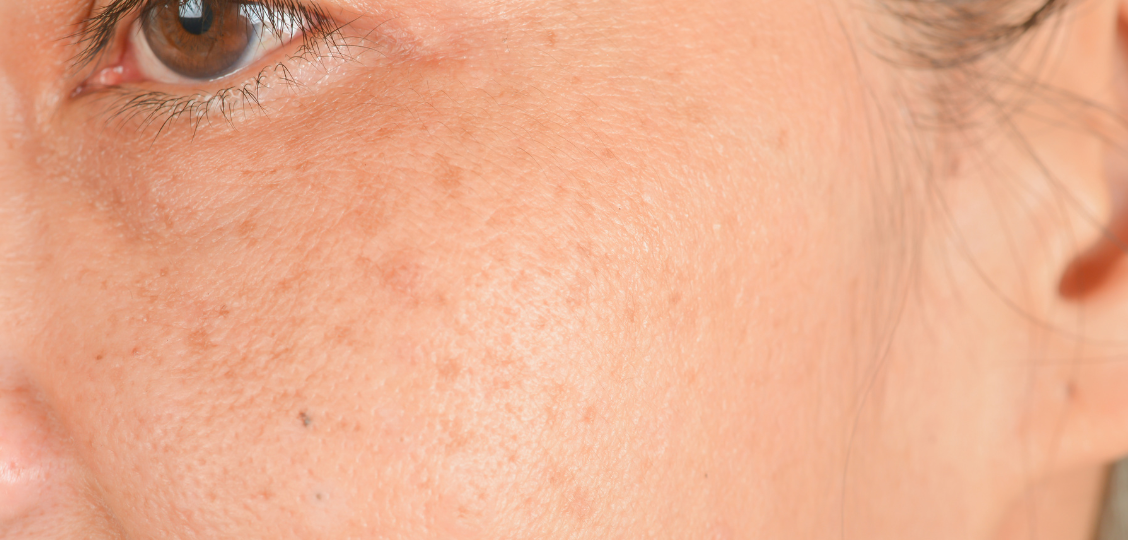 Fleke Od Ekrana Po Licu