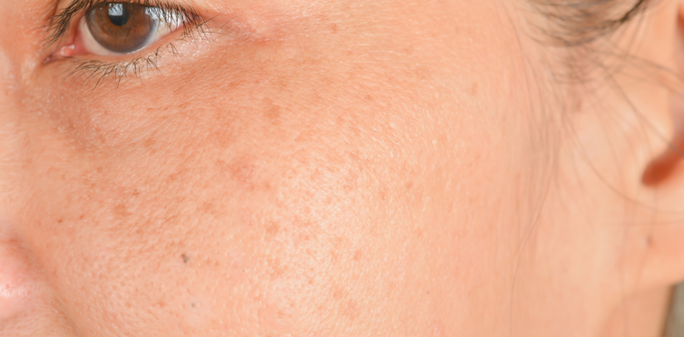 Fleke Od Ekrana Po Licu