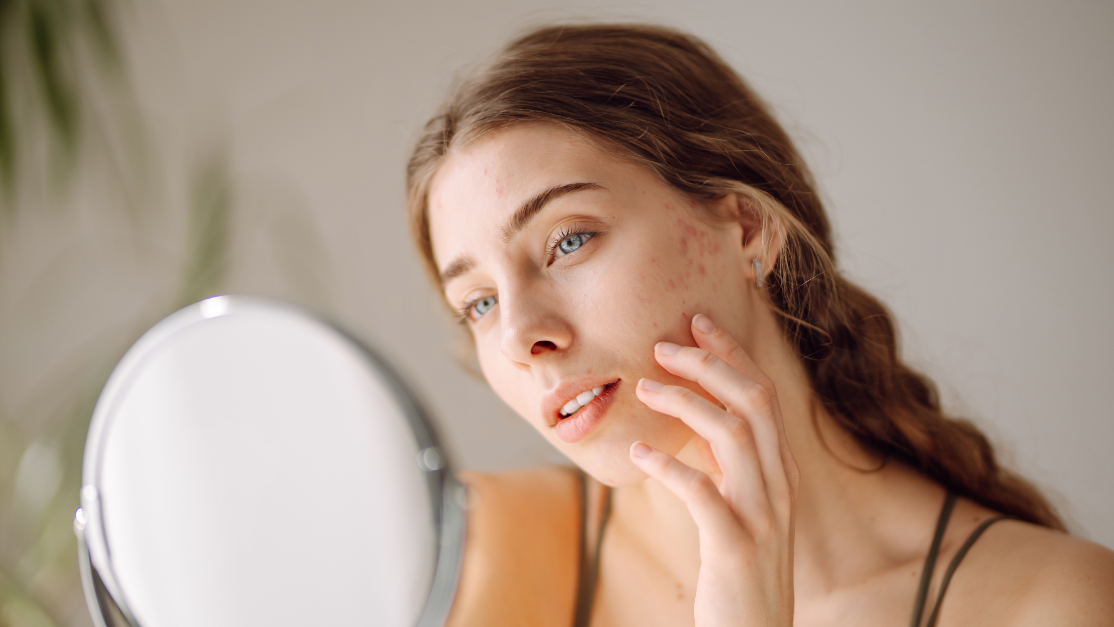 azelaicna kiselina za akne